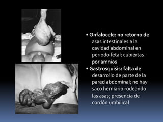 • Onfalocele: no retorno de
asas intestinales a la
cavidad abdominal en
periodo fetal; cubiertas
por amnios
• Gastrosquisis: falta de
desarrollo de parte de la
pared abdominal; no hay
saco herniario rodeando
las asas; presencia de
cordón umbilical
 