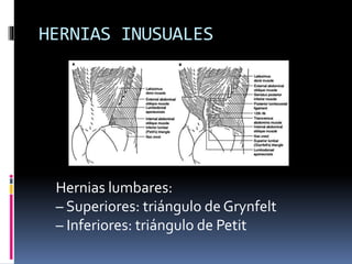 HERNIAS INUSUALES
Hernias lumbares:
– Superiores: triángulo de Grynfelt
– Inferiores: triángulo de Petit
 
