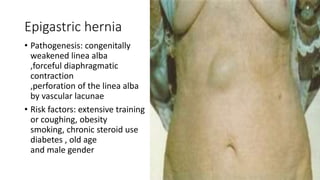 Epigastric hernia
• Pathogenesis: congenitally
weakened linea alba
,forceful diaphragmatic
contraction
,perforation of the linea alba
by vascular lacunae
• Risk factors: extensive training
or coughing, obesity
smoking, chronic steroid use
diabetes , old age
and male gender
 