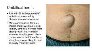 Umbilical hernia
• Found in 23 to 50 percent of
individuals screened by
physical exam or ultrasound
• More commonly in females
than in males with a 3:1 ratio.
In men, umbilical hernias most
often present incarcerated,
whereas females, particularly
those close to their ideal body
weight, are more likely to have
an easily reducible mass
 