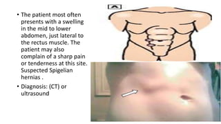 • The patient most often
presents with a swelling
in the mid to lower
abdomen, just lateral to
the rectus muscle. The
patient may also
complain of a sharp pain
or tenderness at this site.
Suspected Spigelian
hernias .
• Diagnosis: (CT) or
ultrasound
 