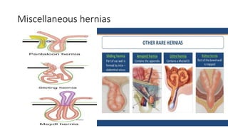 Miscellaneous hernias
 