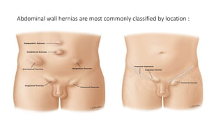 Abdominal wall hernias are most commonly classified by location :
 