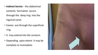 • Indirect hernia – the abdominal
contents herniation occurs
through the deep ring into the
inguinal canal.
• Comes out through the superficial
ring.
• It may extend into the scrotum.
• Depending upon extent it may be
complete or incomplete.
 