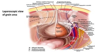 Laparoscopic view
of groin area
 