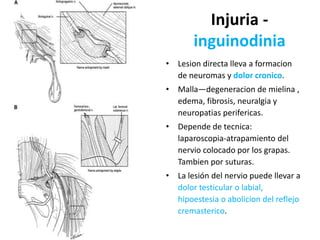 Injuria -
inguinodinia
• Lesion directa lleva a formacion
de neuromas y dolor cronico.
• Malla—degeneracion de mielina ,
edema, fibrosis, neuralgia y
neuropatias perifericas.
• Depende de tecnica:
laparoscopia-atrapamiento del
nervio colocado por los grapas.
Tambien por suturas.
• La lesión del nervio puede llevar a
dolor testicular o labial,
hipoestesia o abolicion del reflejo
cremasterico.
 