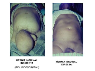 HERNIA INGUINAL
INDIRECTA
(INGUINOESCROTAL)
HERNIA INGUINAL
DIRECTA
 