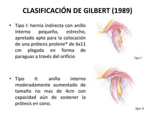 CLASIFICACIÓN DE GILBERT (1989)
• Tipo I: hernia indirecta con anillo
interno pequeño, estrecho,
apretado apto para la colocación
de una prótesis prolene® de 6x11
cm plegada en forma de
paraguas a través del orificio
• Tipo II: anillo interno
moderadamente aumentado de
tamaño no mas de 4cm con
capacidad aún de sostener la
prótesis en cono.
 