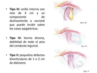 • Tipo III: anillo interno con
más de 4 cm y un
componente de
deslizamiento o escrotal
que puede incidir sobre
los vasos epigástricos.
• Tipo IV: hernia directa,
debilidad de todo el piso
del conducto inguinal.
• Tipo V: pequeños defectos
diverticulares de 1 o 2 cm
de diámetro
 