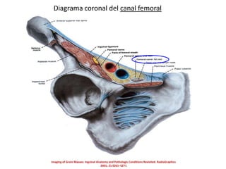 Diagrama coronal del canal femoral
Imaging of Groin Masses: Inguinal Anatomy and Pathologic Conditions Revisited. RadioGraphics
2001; 21:S261–S271
 