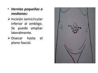 • Hernias pequeñas o
medianas:
 Incisión semicircular
inferior al ombligo.
Se puede ampliar
lateralmente.
 Disecar hasta el
plano fascial.
 
