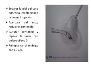  Separar la piel del saco
adherido, manteniendo
la buena irrigación.
 Apertura del saco,
reducir el contenido.
 Suturar peritoneo y
reparar la fascia con
polipropileno 0.
 Reimplantar el ombligo
con CC 2/0.
 