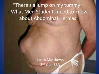 “There’s a lump on my tummy”
- What Med Students need to know
about Abdominal Hernias
Jacob Matthews
3rd Year SSA
 