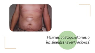 Hernias postoperatorias o
incisionales (eventraciones)
 
