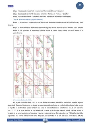Hernias
Hernias. Generalidades Dr. Juan Hernandez Orduña
35
Etapa 1. Localizada medial a la vena femoral (hernia de Cloquet y Laugier)
Etapa 2. Localizada a nivel de los vasos femorales (hernias de Velpeau y Serafini)
Etapa 3. Localizada lateral a los vasos femorales (hernias de Hesselbach y Partridge)
Tipo V. Antero posterior (inguinofemoral).
Etapa 1. A levantado o destruido una porción del ligamento inguinal entre la cresta púbica y vena
femoral.
Etapa 2. Ha levantado o destruido el ligamento inguinal desde la cresta púbica hasta la vena femoral.
Etapa 3. Ha destruido el ligamento inguinal desde la cresta púbica hasta un punto lateral a la
vena femoral.
(Tomado de Carbonelli, 2001).
En el plan de clasificación TSD, la "D" se refiere al diámetro del defecto herniario a nivel de la pared
abdominal. Cuando el defecto no es circular sino que es ovoide o elíptico, la medición latero lateral más amplia
se registra en centímetros. Existe también una serie de subclasificaciones para hernias tipo 2 con las letras
"m", "l", "c" o "e" que denotan si un defecto se localiza en la porción medial, lateral, central o toda la
longitud de la pared posterior del conducto Inguinal, respectivamente. Son ejemplos de TSD de Bendavid las
siguientes: una hernia antero medial cerca del pubis, con diámetro de 2 cm, se rotula como tipo 2, S1 (M),
 