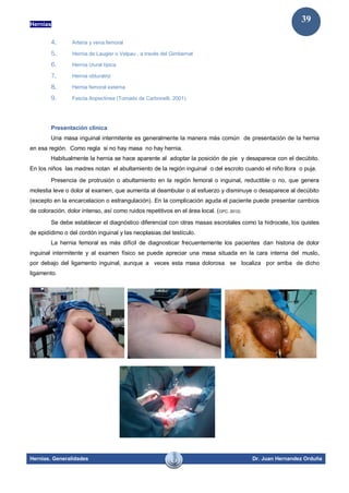 Hernias
Hernias. Generalidades Dr. Juan Hernandez Orduña
39
4. Arteria y vena femoral
5. Hernia de Laugier o Velpau , a través del Gimbernat
6. Hernia crural típica
7. Hernia obturatriz
8. Hernia femoral externa
9. Fascia iliopectinea (Tomado de Carbonelli, 2001).
Presentación clínica
Una masa inguinal intermitente es generalmente la manera más común de presentación de la hernia
en esa región. Como regla si no hay masa no hay hernia.
Habitualmente la hernia se hace aparente al adoptar la posición de pie y desaparece con el decúbito.
En los niños las madres notan el abultamiento de la región inguinal o del escroto cuando el niño llora o puja.
Presencia de protrusión o abultamiento en la región femoral o inguinal, reductible o no, que genera
molestia leve o dolor al examen, que aumenta al deambular o al esfuerzo y disminuye o desaparece al decúbito
(excepto en la encarcelacion o estrangulación). En la complicación aguda el paciente puede presentar cambios
de coloración, dolor intenso, así como ruidos repetitivos en el área local. (GPC, 2012)
Se debe establecer el diagnóstico diferencial con otras masas escrotales como la hidrocele, los quistes
de epidídimo o del cordón inguinal y las neoplasias del testículo.
La hernia femoral es más difícil de diagnosticar frecuentemente los pacientes dan historia de dolor
inguinal intermitente y al examen físico se puede apreciar una masa situada en la cara interna del muslo,
por debajo del ligamento inguinal, aunque a veces esta masa dolorosa se localiza por arriba de dicho
ligamento.
 