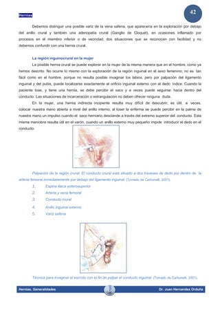 Hernias
Hernias. Generalidades Dr. Juan Hernandez Orduña
42
Debemos distinguir una posible variz de la vena safena, que aparecería en la exploración por debajo
del anillo crural y también una adenopatía crural (Ganglio de Cloquet), en ocasiones inflamado por
procesos en el miembro inferior o de vecindad; dos situaciones que se reconocen con facilidad y no
debemos confundir con una hernia crural.
La región inguinocrural en la mujer
La posible hernia crural se puede explorar en la mujer de la misma manera que en el hombre, como ya
hemos descrito. No ocurre lo mismo con la exploración de la región inguinal en el sexo femenino; no es tan
fácil como en el hombre, porque no resulta posible invaginar los labios, pero por palpación del ligamento
inguinal y del pubis, puede localizarse exactamente el orificio inguinal externo con el dedo índice. Cuando la
paciente tose, y tiene una hernia, se debe percibir el saco y a veces puede seguirse hacia dentro del
conducto. Las situaciones de incarceración o estrangulación no deben ofrecer ninguna duda.
En la mujer, una hernia indirecta incipiente resulta muy difícil de descubrir; es útil, a veces,
colocar nuestra mano abierta a nivel del anillo interno; al toser la enferma se puede percibir en la palma de
nuestra mano un impulso cuando el saco herniario desciende a través del extremo superior del conducto. Esta
misma maniobra resulta útil en el varón, cuando un anillo externo muy pequeño impide introducir el dedo en el
conducto.
Palpación de la región crural. El conducto crural está situado a dos traveses de dedo por dentro de la
arteria femoral inmediatamente por debajo del ligamento inguinal. (Tomado de Carbonelli, 2001).
1. Espina iliaca anterosuperior
2. Arteria y vena femoral
3. Conducto crural
4. Anillo inguinal externo
5. Variz safena
Técnica para invaginar el escroto con el fin de palpar el conducto inguinal. (Tomado de Carbonelli, 2001).
 