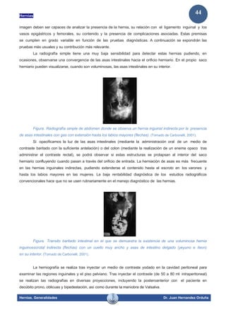 Hernias
Hernias. Generalidades Dr. Juan Hernandez Orduña
44
imagen deben ser capaces de analizar la presencia de la hernia, su relación con el ligamento inguinal y los
vasos epigástricos y femorales, su contenido y la presencia de complicaciones asociadas. Estas premisas
se cumplen en grado variable en función de las pruebas diagnósticas. A continuación se expondrán las
pruebas más usuales y su contribución más relevante.
La radiografía simple tiene una muy baja sensibilidad para detectar estas hernias pudiendo, en
ocasiones, observarse una convergencia de las asas intestinales hacia el orificio herniario. En el propio saco
herniario pueden visualizarse, cuando son voluminosas, las asas intestinales en su interior.
Figura. Radiografía simple de abdomen donde se observa un hernia inguinal indirecta por la presencia
de asas intestinales con gas con extensión hasta los labios mayores (flechas). (Tomado de Carbonelli, 2001).
Si opacificamos la luz de las asas intestinales (mediante la administración oral de un medio de
contraste baritado con la suficiente antelación) o del colon (mediante la realización de un enema opaco tras
administrar el contraste rectal), se podrá observar si estas estructuras se prolapsan al interior del saco
herniario confluyendo cuando pasan a través del orificio de entrada. La herniación de asas es más frecuente
en las hernias inguinales indirectas, pudiendo extenderse el contenido hasta el escroto en los varones y
hasta los labios mayores en las mujeres. La baja rentabilidad diagnóstica de los estudios radiográficos
convencionales hace que no se usen rutinariamente en el manejo diagnóstico de las hernias.
Figura. Transito baritado intestinal en el que se demuestra la existencia de una voluminosa hernia
inguinoescrotal indirecta (flechas) con un cuello muy ancho y asas de intestino delgado (yeyuno e íleon)
en su interior. (Tomado de Carbonelli, 2001).
La herniografía se realiza tras inyectar un medio de contraste yodado en la cavidad peritoneal para
examinar las regiones inguinales y el piso pelviano. Tras inyectar el contraste (de 50 a 80 ml intraperitoneal)
se realizan las radiografías en diversas proyecciones, incluyendo la posteroanterior con el paciente en
decúbito prono, oblicuas y bipedestación, así como durante la maniobra de Valsalva.
 