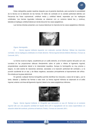 Hernias
Hernias. Generalidades Dr. Juan Hernandez Orduña
45
Estas radiografías pueden repetirse después que el paciente deambule, para aumentar la sensibilidad
de la técnica en la detección de las hernias. El medio de contraste en la cavidad peritoneal delimita con
frecuencia las fosas supravesical, umbilical media y umbilical lateral, separadas por los repliegues
umbilicales. Las hernias inguinales indirectas se observan con un contorno lateral liso y continuo,
laterales al repliegue umbilical lateral por donde discurren los vasos epigástricos.
Las hernias directas presentan una muesca lateral por la impronta de los vasos epigástricos inferiores
.
Figura. Herniografía.
A. Hernia inguinal indirecta izquierda con extensión escrotal (flechas). Nótese las improntas
normales de los repliegues umbilicales en el lado derecho. Hernia inguinal directa bilateral (flechas). (Tomado de
Carbonelli, 2001).
La hernia crural se origina, usualmente por un cuello estrecho, en el borde superior del pubis con una
curvatura en las proyecciones oblicuas directamente sobre el pubis e inferior al ligamento inguinal,
proyectándose usualmente lateral a la tuberosidad isquiática. Aunque la herniografía es muy precisa y
segura, no está exenta de reacciones adversas, asociadas a la inyección peritoneal del contraste y a la
punción accidental de un asa, y de falsos negativos, asociados principalmente al taponamiento del orificio
De entrada por la grasa abdominal.
En general, cualquier técnica tomográfica permite identificar los músculos y vasos de la ingle y, por lo
tanto, detectar y clasificar las hernias a este nivel. La hernia inguinal indirecta se observará en el anillo
inguinal, anterior a la línea del ligamento inguinal, lateral a los vasos epigástricos inferiores.
Figura Hernia Inguinal Indirecta. A. Ecografía que demuestra un asa (H, flechas) en el conducto
inguinal alto con una pequeña cantidad de líquido libre (LP) e ingurgitación de los vasos espermáticos en
situación distal del conducto, próximos al testículo (Testic). (Tomado de Carbonelli, 2001).
 