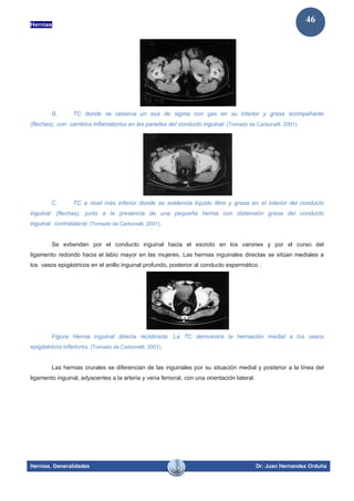 Hernias
Hernias. Generalidades Dr. Juan Hernandez Orduña
46
B. TC donde se observa un asa de sigma con gas en su interior y grasa acompañante
(flechas), con cambios inflamatorios en las paredes del conducto inguinal. (Tomado de Carbonelli, 2001).
C. TC a nivel más inferior donde se evidencia líquido libre y grasa en el interior del conducto
inguinal (flechas), junto a la presencia de una pequeña hernia con distensión grasa del conducto
inguinal contralateral. (Tomado de Carbonelli, 2001).
Se extienden por el conducto inguinal hacia el escroto en los varones y por el curso del
ligamento redondo hacia el labio mayor en las mujeres. Las hernias inguinales directas se sitúan mediales a
los vasos epigástricos en el anillo inguinal profundo, posterior al conducto espermático .
Figura Hernia inguinal directa recidivada. La TC demuestra la herniación medial a los vasos
epigástricos inferiores. (Tomado de Carbonelli, 2001).
Las hernias crurales se diferencian de las inguinales por su situación medial y posterior a la línea del
ligamento inguinal, adyacentes a la arteria y vena femoral, con una orientación lateral.
 
