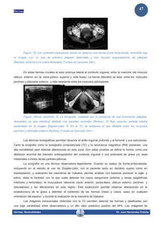 Hernias
Hernias. Generalidades Dr. Juan Hernandez Orduña
47
Figura. TC con contraste intravenoso donde se observa una hernia crural incarcerada, reversible tras
la cirugía, con un asa de intestino delgado distendida y con discreto engrosamiento de pliegues
(flechas), próxima a los vasos femorales. (Tomado de Carbonelli, 2001).
En estas hernias crurales el saco protruye lateral al conducto inguinal, entre la inserción del músculo
oblicuo externo en la rama púbica superior y este hueso. La hernia obturatriz se sitúa entre los músculos
pectíneo y obturador externo , y más raramente entre los músculos obturadores.
Figura. Hernia obturatriz. A. La Ecografía, realizada por la presencia de una tumoración palpable,
demuestra un asa intestinal dilatada con paredes normales (flechas). El flujo vascular parietal estaba
aumentado en la imagen Doppler-color. B. En la TC se evidencia el asa dilatada entre los músculos
pectíneo y obturador externo (flechas). (Tomado de Carbonelli, 2001).
Las técnicas tomográficas permiten observar el anillo inguinal profundo y el femoral, y sus estructuras.
Tanto la ecografía como la tomografía computarizada (TC) y la resonancia magnética (RM) presentan una
alta sensibilidad para detectar alteraciones en esta zona. Con estas pruebas se define la hernia como una
dilatación anormal del diámetro anteroposterior del conducto inguinal o una protrusión de grasa y/o asas
intestinales a través de las paredes pélvicas.
La ecografía es una técnica observadora dependiente. Cuando se realiza de forma protocolizada,
incluyendo en el estudio el uso de Doppler-color, con el paciente tanto en decúbito supino como en
bipedestación, y realizando las maniobras de Valsalva, permite analizar con bastante precisión la ingle y
pelvis, dada la facilidad con la que suele detectar los vasos sanguíneos (arterias y venas epigástricas
inferiores y femorales), la musculatura relevante (recto anterior, psoas-iliaco, oblicuo externo, pectíneo y
obturadores) y las alteraciones en esta región. Esta exploración permite observar alteraciones en la
ecoestructura de la grasa y delimitar el contenido de las hernias (meso y vasos, asas) en cualquier
orientación del espacio y durante la realización de la maniobra de Valsalva.
Las imágenes transversales obtenidas con la TC permiten detectar las hernias y clasificarlas con
una baja variabilidad entre observadores y un alto valor predictivo positivo del 94%. Las imágenes de
 