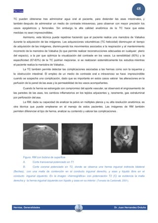 Hernias
Hernias. Generalidades Dr. Juan Hernandez Orduña
48
TC pueden obtenerse tras administrar agua oral al paciente, para distender las asas intestinales, y
también después de administrar un medio de contraste intravenoso, para observar con mayor precisión los
vasos epigástricos y femorales. Sin embargo, la alta calidad anatómica de la TC hace que estas
medidas no sean imprescindibles.
Asimismo, esta técnica puede repetirse haciendo que el paciente realice una maniobra de Valsalva
durante la adquisición de las imágenes. Las adquisiciones volumétricas (TC helicoidal) disminuyen el tiempo
de adquisición de las imágenes, disminuyendo los movimientos asociados a la respiración y al mantenimiento
incorrecto de la maniobra de Valsalva (lo que permite realizar reconstrucciones adecuadas en cualquier plano
del espacio), a la par que optimiza la visualización del contraste en los vasos. La sensibilidad (83%) y la
especificidad (67-83%) de la TC podrían mejorarse, si se realizaran sistemáticamente los estudios mientras
el paciente realiza la maniobra de Valsalva .
La TC también permite detectar las complicaciones asociadas a las hernias como son la isquemia y
la obstrucción intestinal. El empleo de un medio de contraste oral e intravenoso se hace imprescindible
cuando se sospecha una complicación, dado que es importante en estos casos valorar las alteraciones en la
perfusión de la pared de las asas y la permeabilidad de los vasos acompañantes.
Cuando la hernia se estrangula con compromiso del aporte vascular, se observará el engrosamiento de
las paredes de las asas, los cambios inflamatorios en los tejidos adyacentes y, raramente, gas extraluminal
por perforación del asa.
La RM, dada su capacidad de analizar la pelvis en múltiples planos y su alta resolución anatómica, es
otra técnica que puede emplearse en el manejo de estos pacientes. Las imágenes de RM también
permiten diferenciar el tipo de hernia, analizar su contenido y valorar las complicaciones .
Figura. RM con bobina de superficie
A. Corte transversal potenciado en T1.
B. Corte coronal potenciado en T2, donde se observa una hernia inguinal indirecta bilateral
(flechas), con una malla de contención en el conducto inguinal derecho, y asas y líquido libre en el
conducto inguinal izquierdo. En la imagen «herniográfica» con potenciación T2 (C) se evidencia la malla
derecha y la hernia inguinal izquierda con líquido y asas en su interior. (Tomado de Carbonelli, 2001).
 