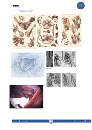 Hernias
Hernias. Generalidades Dr. Juan Hernandez Orduña
56
Tipos de reparación
 