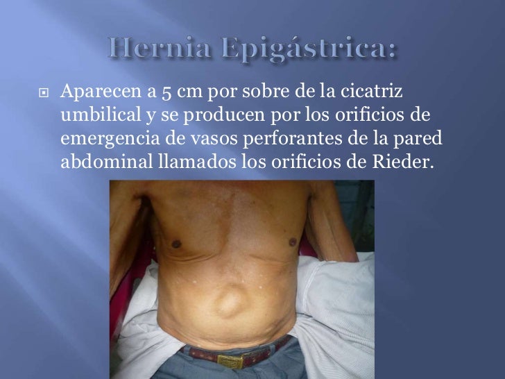 Hernias, presentación. Dr. Martinez T