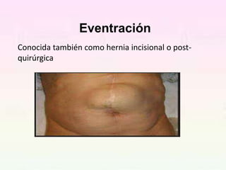 hernias seminario médico de hernias pptx | PPTX
