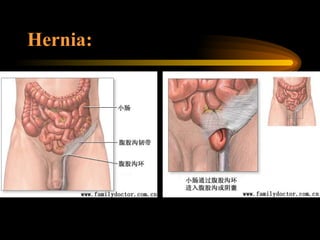 Hernia: 