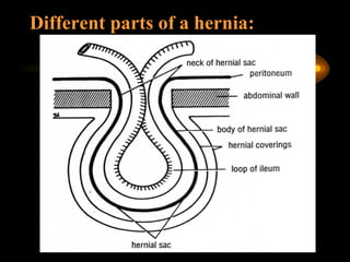 Different parts of a hernia:   