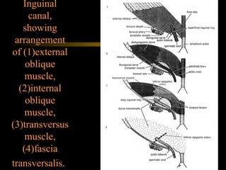 Inguinal canal, showing arrangement of (1)external oblique muscle, (2)internal oblique muscle, (3)transversus muscle, (4)fascia transversalis.   
