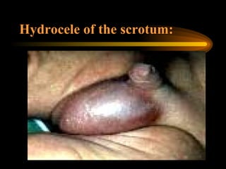 Hydrocele of the scrotum: 