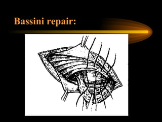Bassini repair: 