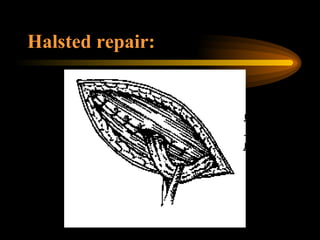 Halsted repair: 