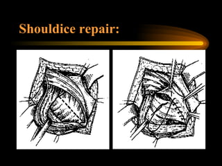 Shouldice repair: 
