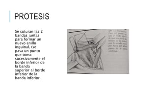 hernias(1).pptx