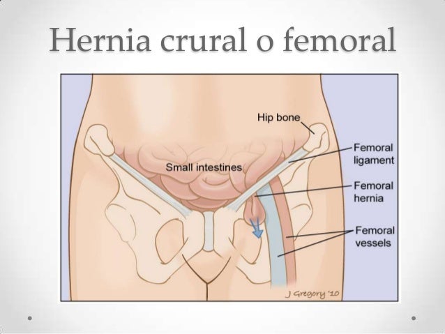 Hernia crural