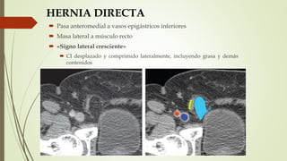 HERNIA DIRECTA
 Pasa anteromedial a vasos epigástricos inferiores
 Masa lateral a músculo recto
 «Signo lateral cresciente»
 CI desplazado y comprimido lateralmente, incluyendo grasa y demás
contenidos
 