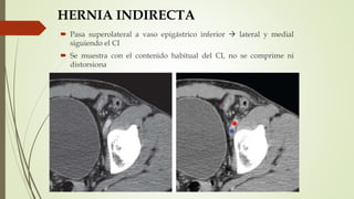 HERNIA INDIRECTA
 Pasa superolateral a vaso epigástrico inferior  lateral y medial
siguiendo el CI
 Se muestra con el contenido habitual del CI, no se comprime ni
distorsiona
 
