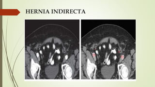 HERNIA INDIRECTA
 