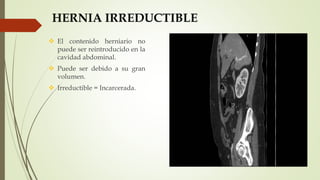 HERNIA IRREDUCTIBLE
 El contenido herniario no
puede ser reintroducido en la
cavidad abdominal.
 Puede ser debido a su gran
volumen.
 Irreductible = Incarcerada.
 