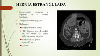 HERNIA ESTRANGULADA
 Compromiso vascular e
isquemia de la víscera
herniada.
 Complicación más grave.
 Hallazgos:
 Engrosamiento pared
 TC: Hipo o hiperdensidad
en su pared, así como
reforzamiento variable
 Estriación de grasa
mesentérica
 Ascitis
 