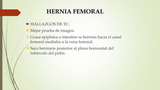 HERNIA FEMORAL
 HALLAZGOS DE TC:
 Mejor prueba de imagen.
 Grasa epiploica o intestino se hernian hacia el canal
femoral mediales a la vena femoral.
 Saco herniario posterior al plano horizontal del
tubérculo del pubis.
 