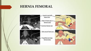 HERNIA FEMORAL
 