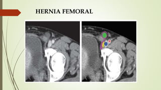HERNIA FEMORAL
 