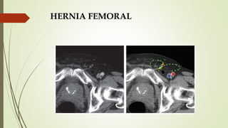 HERNIA FEMORAL
 