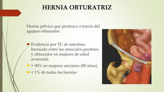 HERNIA OBTURATRIZ
Hernia pélvica que protruye a través del
agujero obturador.
 Evidencia por TC de intestino
herniado entre los músculos pectíneo
y obturador en mujeres de edad
avanzada
 > 90% en mujeres ancianas (80 años).
 < 1% de todas las hernias
 