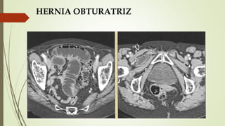HERNIA OBTURATRIZ
 