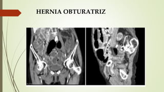 HERNIA OBTURATRIZ
 